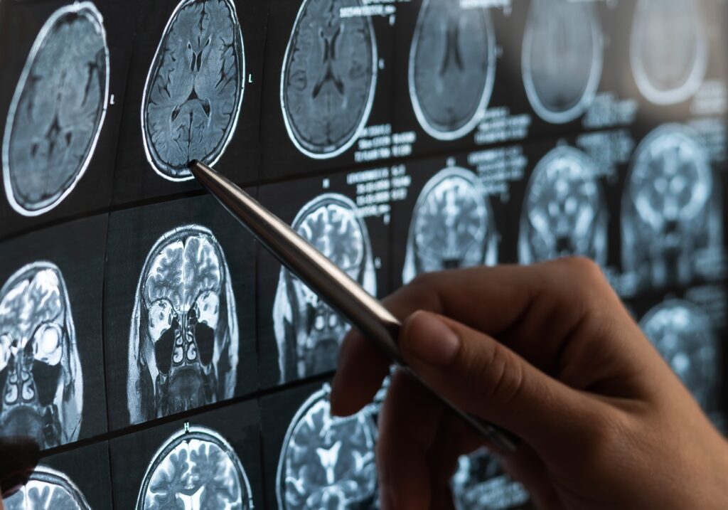 MRI Misdiagnosis: Common Errors and How to Avoid Them